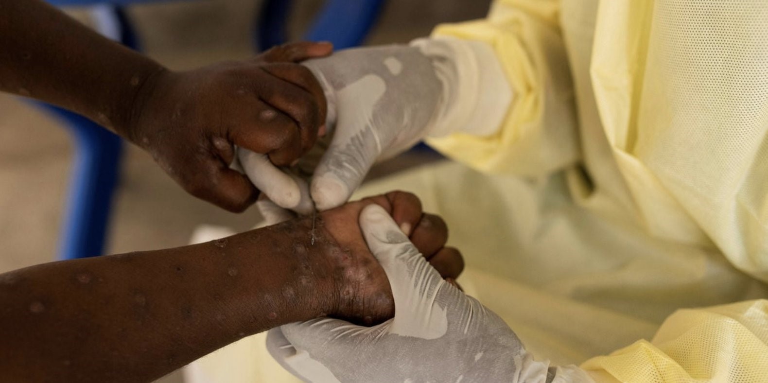 health officer handling an MPOX DISEASE PATENT